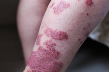 Psoriasis vulgaris etkiler deri, özellikle Tıbbi dergiler için detay fotoğraf otoimmün bir hastalıktır. Atopik dermatit veya egzama, ayak, deri iltihabı türüdür.