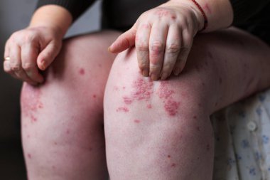 Kadın el ile kaşıntılı kaşındığın. Sedef veya egzama deri