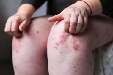 Kadın el ile kaşıntılı kaşındığın. Sedef veya egzama deri