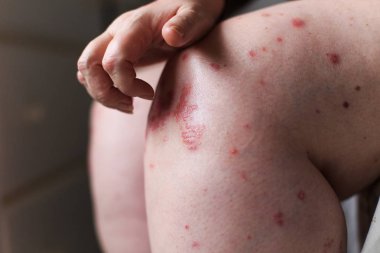 Kadın el ile kaşıntılı kaşındığın. Sedef veya egzama deri