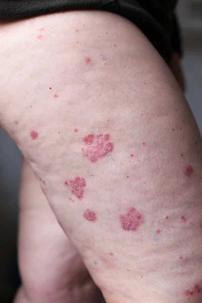 La psoriasis vulgar es una enfermedad autoinmune que afecta a la piel, fotografía detallada para revistas principalmente médicas. La dermatitis atópica o eccema, es un tipo de inflamación de la piel en los pies. . — Foto de Stock