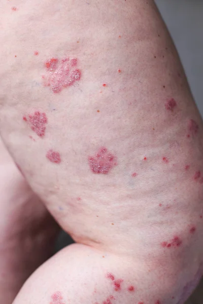 A psoríase vulgar é uma doença autoimune que afeta a pele, fotografia detalhada para revistas principalmente médicas. Dermatite atópica ou eczema, é um tipo de inflamação da pele a pé . — Fotografia de Stock