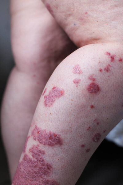 Psoriasis vulgaris is an autoimmune disease that affects the skin, detail photography for mainly medical magazines. Atopic dermatitis or eczema, is a type of inflammation of the skin at foot.