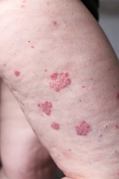 Psoriasis vulgaris egy autoimmun betegség, amely hatással van a bőr, a részletek fotózás-főleg orvosi magazinok. Atópiás dermatitis vagy ekcéma, egyfajta lábánál bőrgyulladás. — Stock Fotó