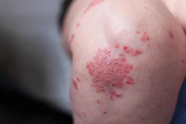 A psoríase vulgar é uma doença autoimune que afeta a pele, fotografia detalhada para revistas principalmente médicas. Dermatite atópica ou eczema, é um tipo de inflamação da pele a pé . — Fotografia de Stock