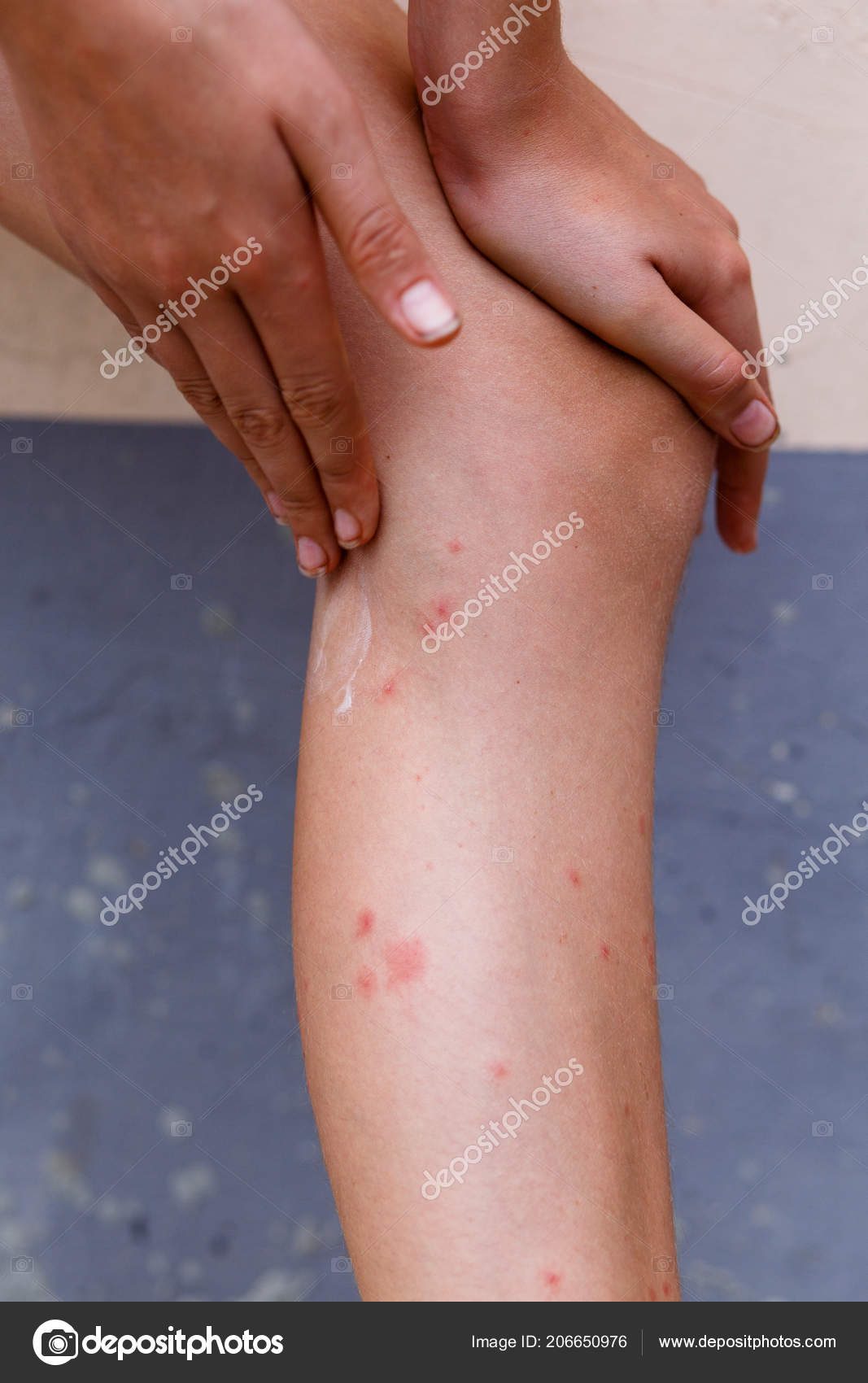 Red bumps on legs deals