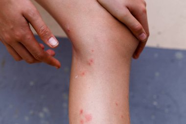 Ayakları, böcek sokması ve stings sağlık ve tıbbi görüntüleme ve tasarlayarak kavramlar neden'ın bahçesinde kaşıntı kadınlarla.