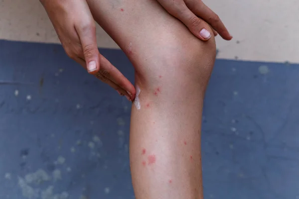 Coçar Inchaços Vermelhos Com Comichão Macios Pele Picadas Mosquito Perna — Fotografia de Stock