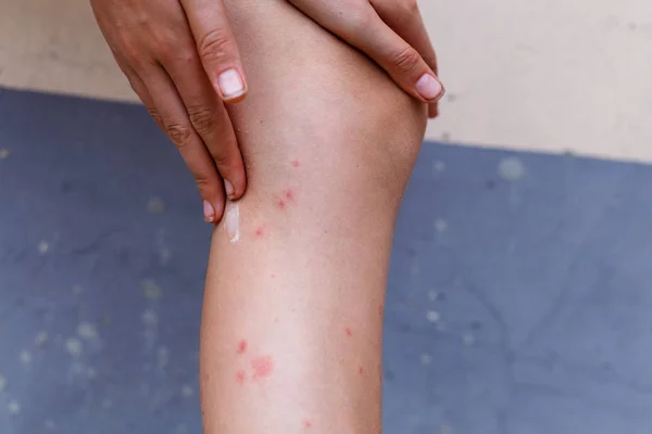 Царапайте Мягкие Зудящие Красные Шишки Коже Укусов Комаров Левой Ноге — стоковое фото