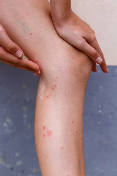 Scratch Soft Itchy Red Bumps Skin Mosquito Bites Left Leg — Stock Photo, Image