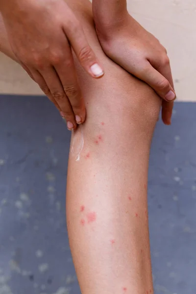 Царапайте Мягкие Зудящие Красные Шишки Коже Укусов Комаров Левой Ноге — стоковое фото