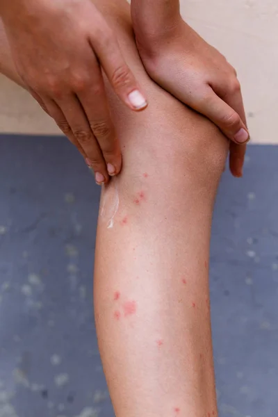 Coçar Inchaços Vermelhos Com Comichão Macios Pele Picadas Mosquito Perna — Fotografia de Stock