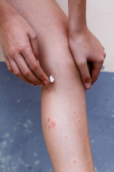 昆虫咬傷と刺傷の健康と医療のビューおよび案出する概念による芝生のかゆみ彼の足を持つ女性 — ストック写真
