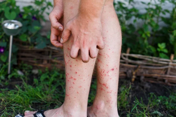 Mann Kratzt Den Juckreiz Mit Hand Bein Juckreiz Konzept Mit — Stockfoto