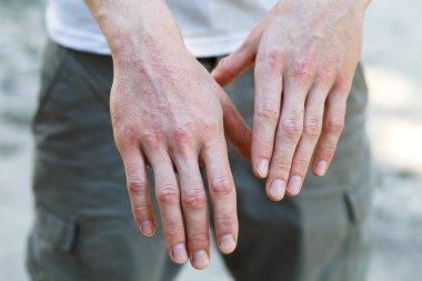 Psoriasis vulgaris on the mans hands with plaque, rash and patches on skin. Autoimmune genetic disease. Close up view clipart