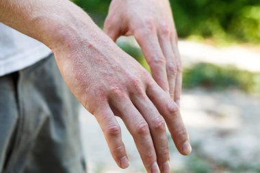 Psoriasis vulgaris üzerinde plak, döküntü ellerle mans ve yamalar cilt üzerinde. Otoimmün hastalığı genetik. Görünümü kapatın