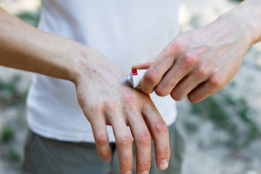 Sedef hastalığı, egzama ve diğer kuru cilt durumlarında olduğu gibi kuru cilt için de bir emollient uygulanır.