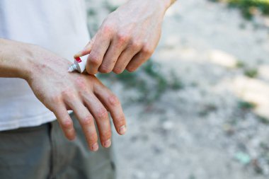 applying an emollient to dry flaky skin as in the treatment of psoriasis, eczema and other dry skin conditions clipart