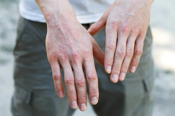 Psoriasis Vulgaris Mans Rukou Pamětní Deskou Vyrážka Skvrny Kůži Autoimunitní — Stock fotografie