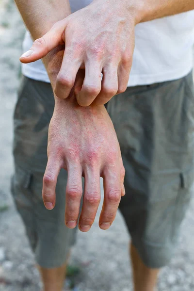 Het Probleem Met Veel Mensen Eczeem Bij Hand — Stockfoto