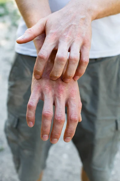 Problem Many People Eczema Hand — Stock Photo, Image