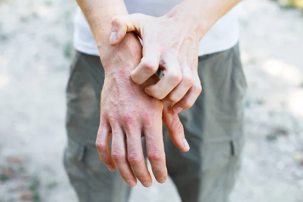 Problème Avec Beaucoup Gens Eczéma Portée Main — Photo