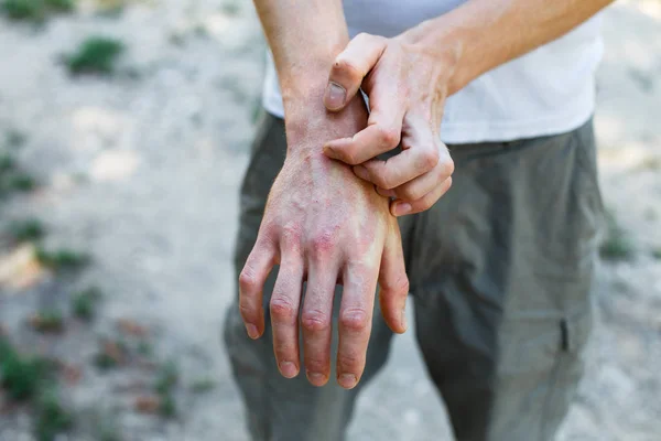 Problem Many People Eczema Hand — Stock Photo, Image