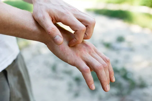 Problema Com Muitas Pessoas Eczema Mão — Fotografia de Stock