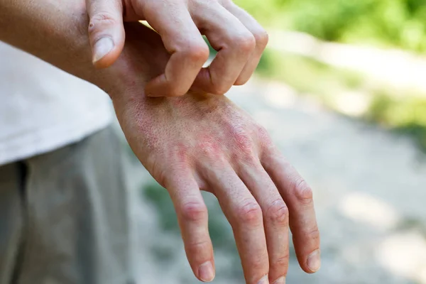 Problem Many People Eczema Hand — Stock Photo, Image