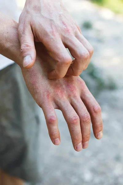 Problema Com Muitas Pessoas Eczema Mão — Fotografia de Stock