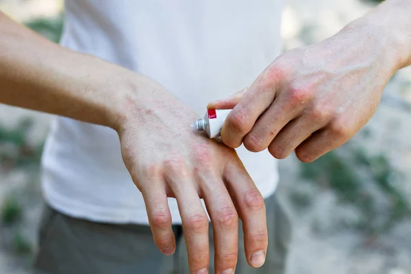 Aplicação Emoliente Pele Seca Escamosa Como Tratamento Psoríase Eczema Outras — Fotografia de Stock