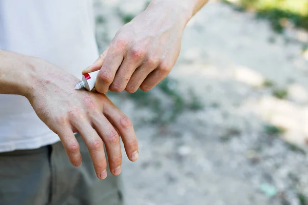 Aplicar Emoliente Sobre Piel Seca Escamosa Como Tratamiento Psoriasis Eccema — Foto de Stock