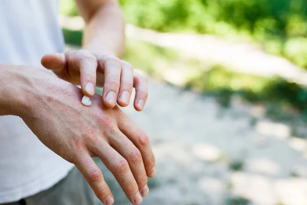 Applicera Ett Mjukgörande Torr Flagnande Hud Som Vid Behandling Psoriasis — Stockfoto