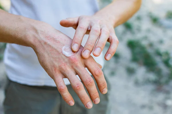 Salbe Zur Hand Anwendung Der Salbe Bei Der Behandlung Und — Stockfoto