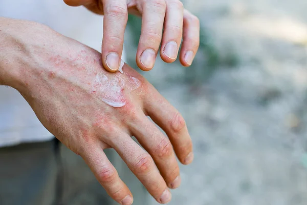 药膏在手上 软膏在皮肤的治疗和水化中的应用 — 图库照片