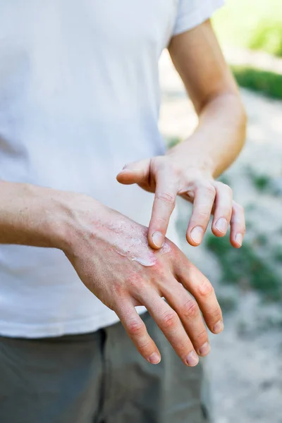 Ointment Hand Applying Ointment Treatment Hydration Skin — Stock Photo, Image