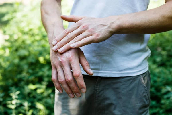 Ointment Hand Applying Ointment Treatment Hydration Skin — Stock Photo, Image