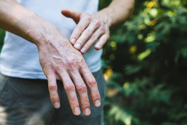 Maść Rękę Stosowanie Maści Leczeniu Nawilżenie Skóry — Zdjęcie stockowe