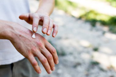 Sedef hastalığı, egzama ve diğer kuru cilt durumlarında olduğu gibi kuru cilt için de bir emollient uygulanır.