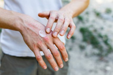 applying an emollient to dry flaky skin as in the treatment of psoriasis, eczema and other dry skin conditions clipart