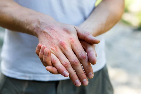 Close Dermatitis Skin Ill Allergic Rash Dermatitis Eczema Skin Patient — Stock Photo, Image