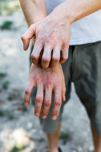 Dermatite Close Pele Dermatite Alérgica Doente Dermatite Eczema Pele Paciente — Fotografia de Stock