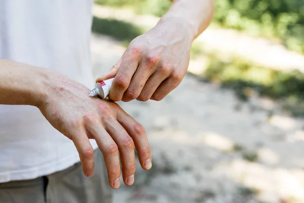 Aplicar Emoliente Sobre Piel Seca Escamosa Como Tratamiento Psoriasis Eccema — Foto de Stock