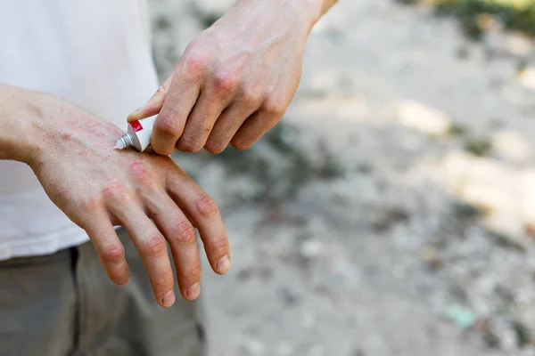 Het Aanbrengen Van Een Verzachtend Middel Droge Schilferige Huid Zoals — Stockfoto