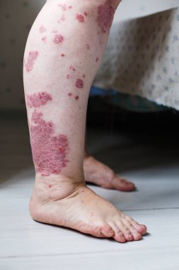 Hasta Alerjik döküntü, egzama cilt hasta, atopik dermatit belirti cilt detay doku, mantar cilt, kavram Dermatoloji, tedavi kapatın. Sedef deri kırmızı lekeler. Bir kadının ayakları