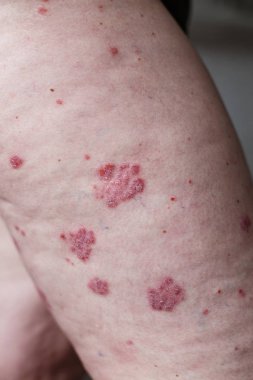 Hasta Alerjik döküntü, egzama cilt hasta, atopik dermatit belirti cilt detay doku, mantar cilt, kavram Dermatoloji, tedavi kapatın. Sedef deri kırmızı lekeler. Bir kadının ayakları