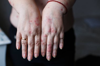 Psoriasis vulgaris plak, döküntü ve cilt üzerinde yamalar ile kadının ellerinde. Otoimmün hastalığı genetik. Sağlık kavramı