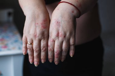 Psoriasis vulgaris plak, döküntü ve cilt üzerinde yamalar ile kadının ellerinde. Otoimmün hastalığı genetik. Sağlık kavramı