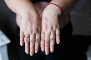Psoriasis vulgaris plak, döküntü ve cilt üzerinde yamalar ile kadının ellerinde. Otoimmün hastalığı genetik. Sağlık kavramı