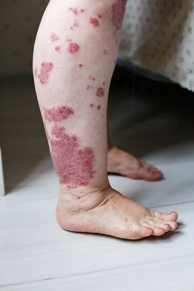 Close up syg allergisk udslæt, eksem hud af patienten, atopisk dermatitis symptom hud detalje tekstur, Svamp af huden, Begrebet dermatologi, behandling. Røde pletter på psoriasis hud. Fødder af en kvinde - Stock-foto